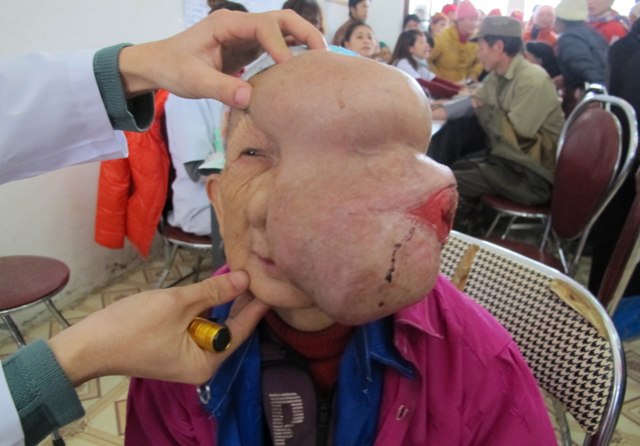 Cụ già 90 tuổi “đeo” khối u quái khổng lồ trên mặt